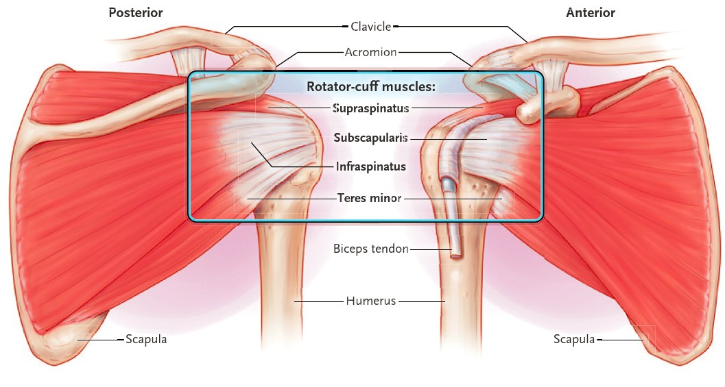 Just published in NEJM 🔥

Degenerative Rotator-Cuff Disorders

👇👇👇

nejm.org/doi/full/10.10…