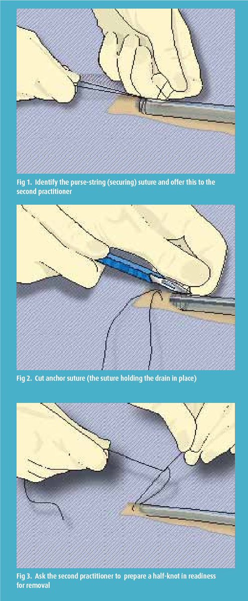 CiruAndes2's tweet photo. Key 🔑 steps and tricks to remove a chest tube: a must know for every med student and intern in their trauma surgery clerkship 🫵🔪💥👁!  @juliomayol @swexner @pferrada1 @PipeCabreraV @drdevirgilio @DrThawaba @topknife @docmartin22 @elliotthaut https://t.co/vC6Is8h697