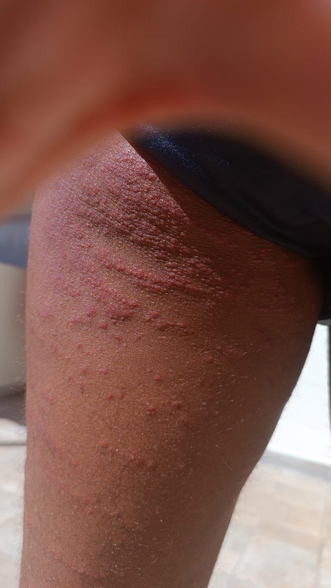 ALERTA: Galera que costuma beber no ximarelinho da Glória, no meio das fendas das cadeiras de madeira está c acumulo de percevejo que acaba soltando uma larva de percevejo causando alergia! 4 pessoas que eu conheço ficaram com a perna muito machucada, entre elas minha namorada +