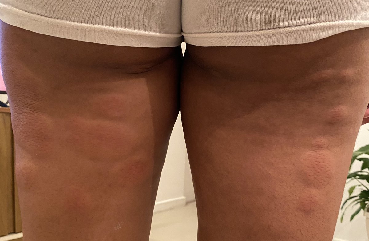 eumayar4_'s tweet photo. ALERTA: Galera que costuma beber no ximarelinho da Glória, no meio das fendas das cadeiras de madeira está c acumulo de percevejo que acaba soltando uma larva de percevejo causando alergia! 4 pessoas que eu conheço ficaram com a perna muito machucada, entre elas minha namorada + https://t.co/tw28ve8VWA