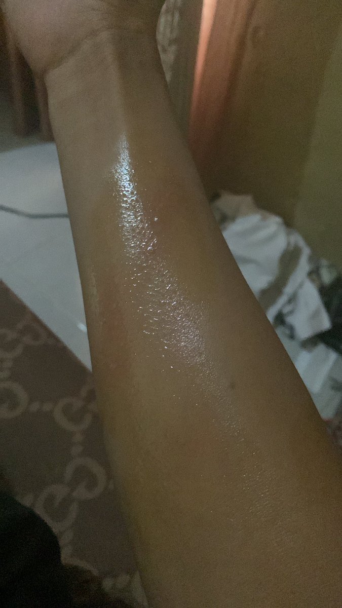 anggitnvn's tweet image. Jam segini, kena tawon alangkah indahnya hidup ini