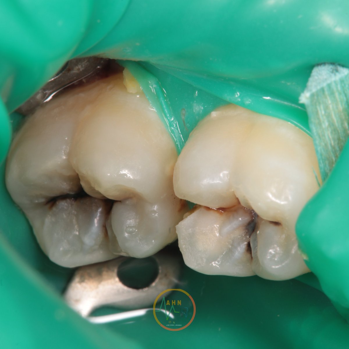 dentist_amar617's tweet image. عمل حشوة لتسوس قريب من العصب تحت العازل المطاطي 
Removal of deep caires followd by plasong composite restoration for  #46
Under rubberdam isolation
#saveatooth  #conservative_dental_treatment