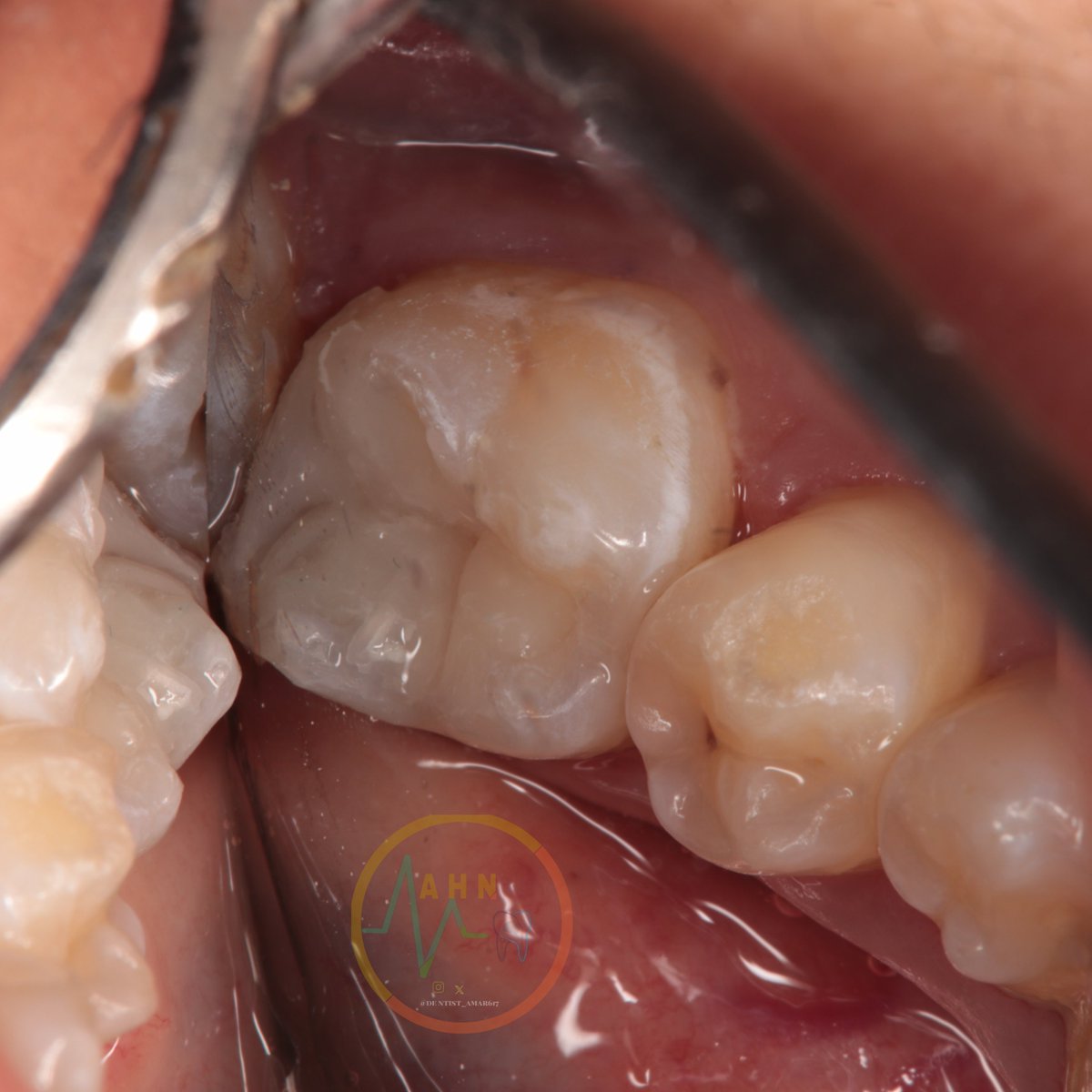 dentist_amar617's tweet image. عمل حشوة لتسوس قريب من العصب تحت العازل المطاطي 
Removal of deep caires followd by plasong composite restoration for  #46
Under rubberdam isolation
#saveatooth  #conservative_dental_treatment