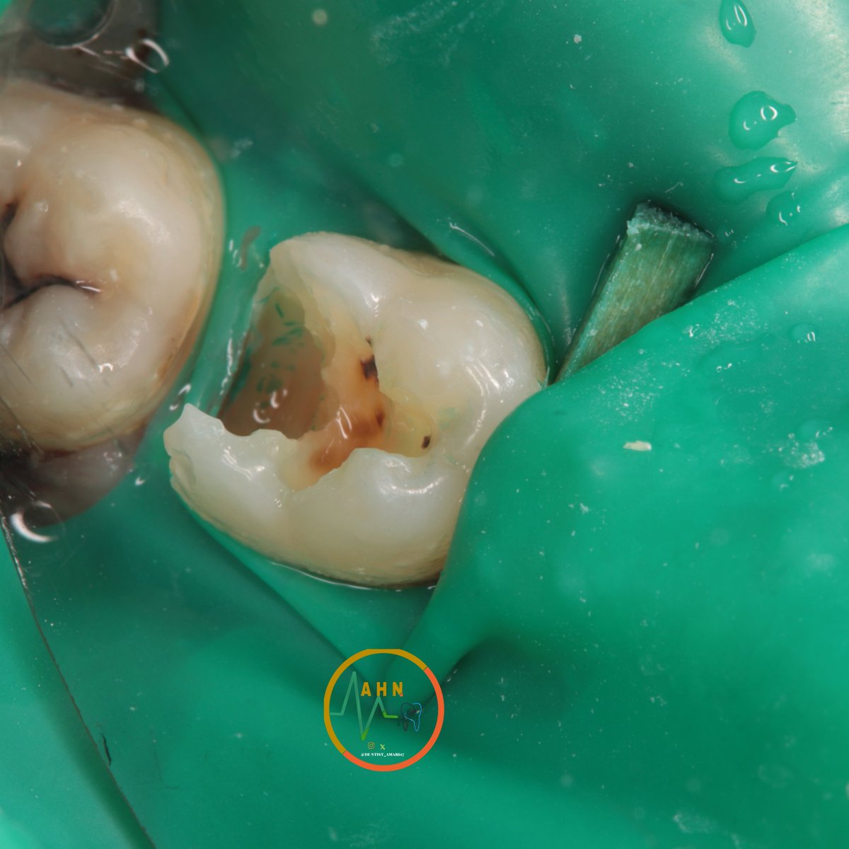 dentist_amar617's tweet image. عمل حشوة لتسوس قريب من العصب تحت العازل المطاطي 
Removal of deep caires followd by plasong composite restoration for  #46
Under rubberdam isolation
#saveatooth  #conservative_dental_treatment