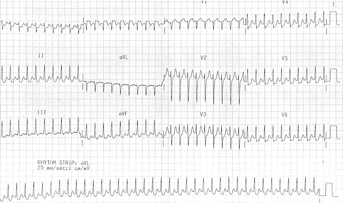 walinjom's tweet photo. Orthodromic
 Atrioventricular Re-entry Tachycardia (AVRT): 

ECG features of AVRT with orthodromic conduction =

1. Rate usually 200-300 bpm

2. Retrograde P waves are usually visible, with a long RP interval

3. QRS < 120ms unless pre-existing bundle branch block, or rate-related aberrant conduction

4. QRS alternans: phasic variation in QRS amplitude associated with AVNT and AVRT, distinguished from electrical alternans by a normal QRS amplitude

5. Rate-related ischaemia is common