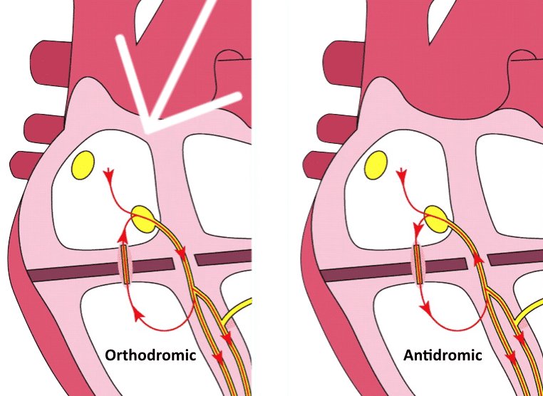 walinjom's tweet photo. Orthodromic
 Atrioventricular Re-entry Tachycardia (AVRT): 

ECG features of AVRT with orthodromic conduction =

1. Rate usually 200-300 bpm

2. Retrograde P waves are usually visible, with a long RP interval

3. QRS < 120ms unless pre-existing bundle branch block, or rate-related aberrant conduction

4. QRS alternans: phasic variation in QRS amplitude associated with AVNT and AVRT, distinguished from electrical alternans by a normal QRS amplitude

5. Rate-related ischaemia is common