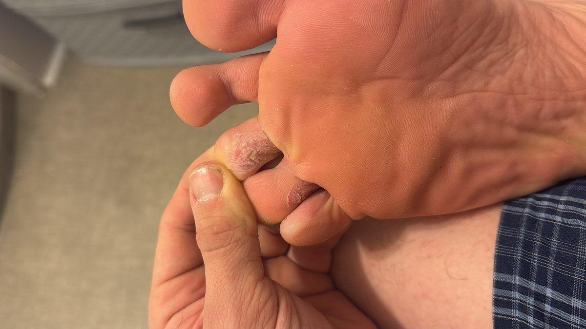 What the f is going on with my toes <a href="/footdoc/">Mark Karam</a>