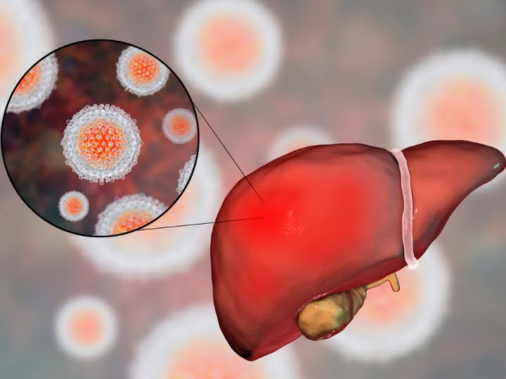 Xalnesiran, combinado con un inmunomodulador, puede inducir una pérdida significativa del HBsAg en pacientes que han alcanzado supresión virológica mediante terapia con análogos de nucleósidos o nucleótidos. ➡️  n9.cl/0nore