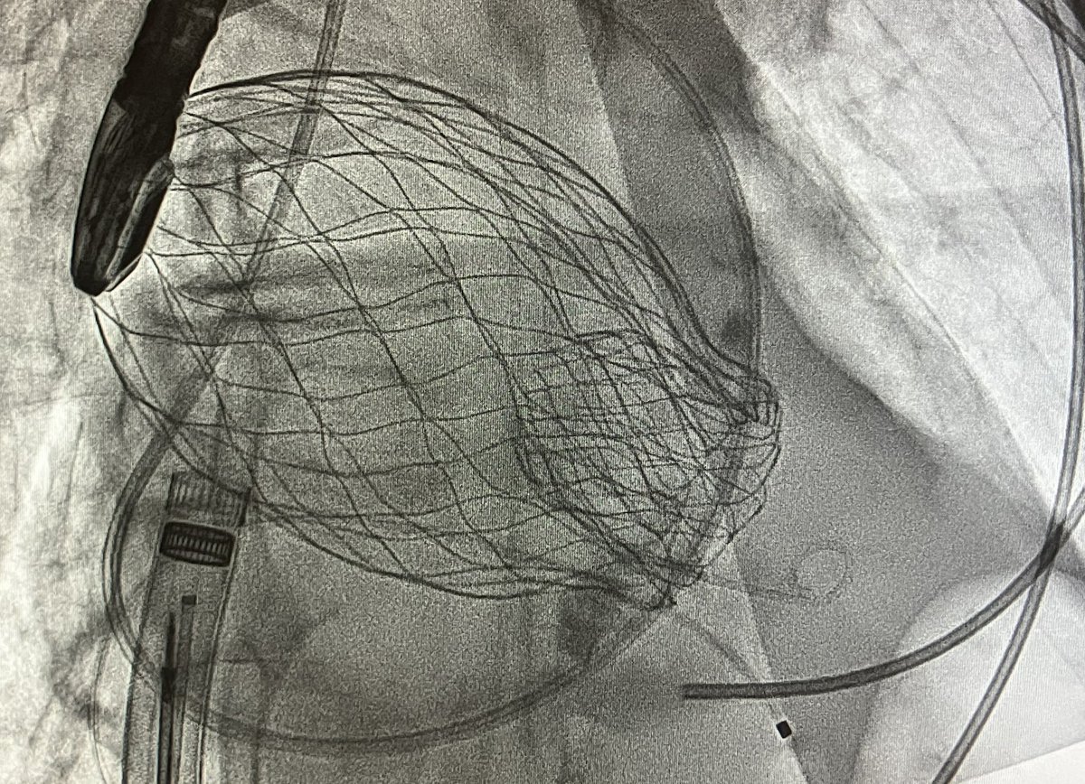 Pier Pasquale Leone (@leoneppmd) on Twitter photo What a Wednesday at <a href="/MonteHeart/">Montefiore Heart</a>!
🥇case of AltaValve in New York
🥇case enrolled in TRINITY EFS study with Lux-Valve Plus
Fantastic to be part of this terrific Team
<a href="/azeemlatib/">Azeem Latib</a> <a href="/jgranadacrf/">Juan F. Granada</a> <a href="/modine_thomas/">thomas modine</a> <a href="/EdwinHoMD/">Edwin Ho</a> <a href="/m_assafin/">Manaf Assafin</a> Tadahisa Sugiura <a href="/AndreaScotti21/">Andrea Scotti</a> <a href="/MatteoSturlaM/">Matteo Sturla</a> What a Wednesday at <a href="/MonteHeart/">Montefiore Heart</a>!
🥇case of AltaValve in New York
🥇case enrolled in TRINITY EFS study with Lux-Valve Plus
Fantastic to be part of this terrific Team
<a href="/azeemlatib/">Azeem Latib</a> <a href="/jgranadacrf/">Juan F. Granada</a> <a href="/modine_thomas/">thomas modine</a> <a href="/EdwinHoMD/">Edwin Ho</a> <a href="/m_assafin/">Manaf Assafin</a> Tadahisa Sugiura <a href="/AndreaScotti21/">Andrea Scotti</a> <a href="/MatteoSturlaM/">Matteo Sturla</a>