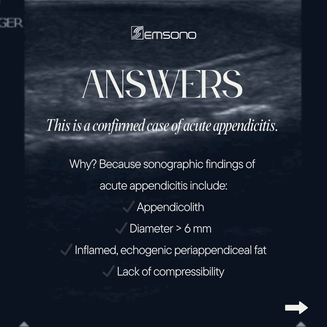 EMsonoPOCUS's tweet photo. This is a confirmed case of acute appendicitis. Why? 🔍

Yes. Sonographic findings include:

✅Appendicolith
✅Diameter > 6 mm
✅Inflamed, echogenic periappendiceal fat
✅Lack of compressibility https://t.co/6ICXo8YLJw