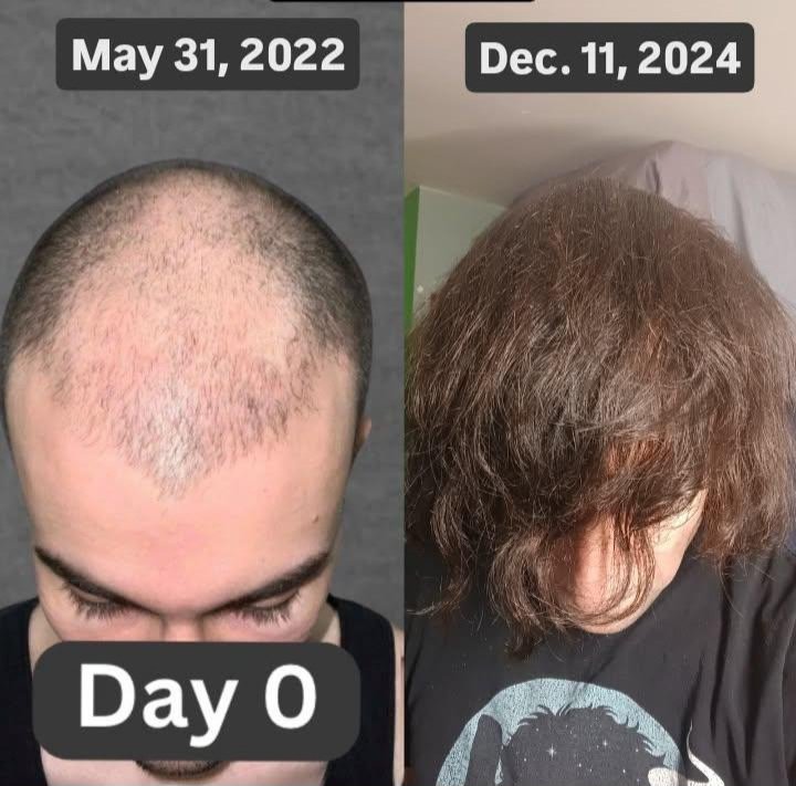 LoganRaposo_'s tweet photo. 1 year post op on my hair transplant
You can see the original day 0 picture before I began my hair recovery journey and present day.
It's been a wild ride thus far.
#HairTransplant #HairRecovery #HairHealth https://t.co/h6wFSbI77u