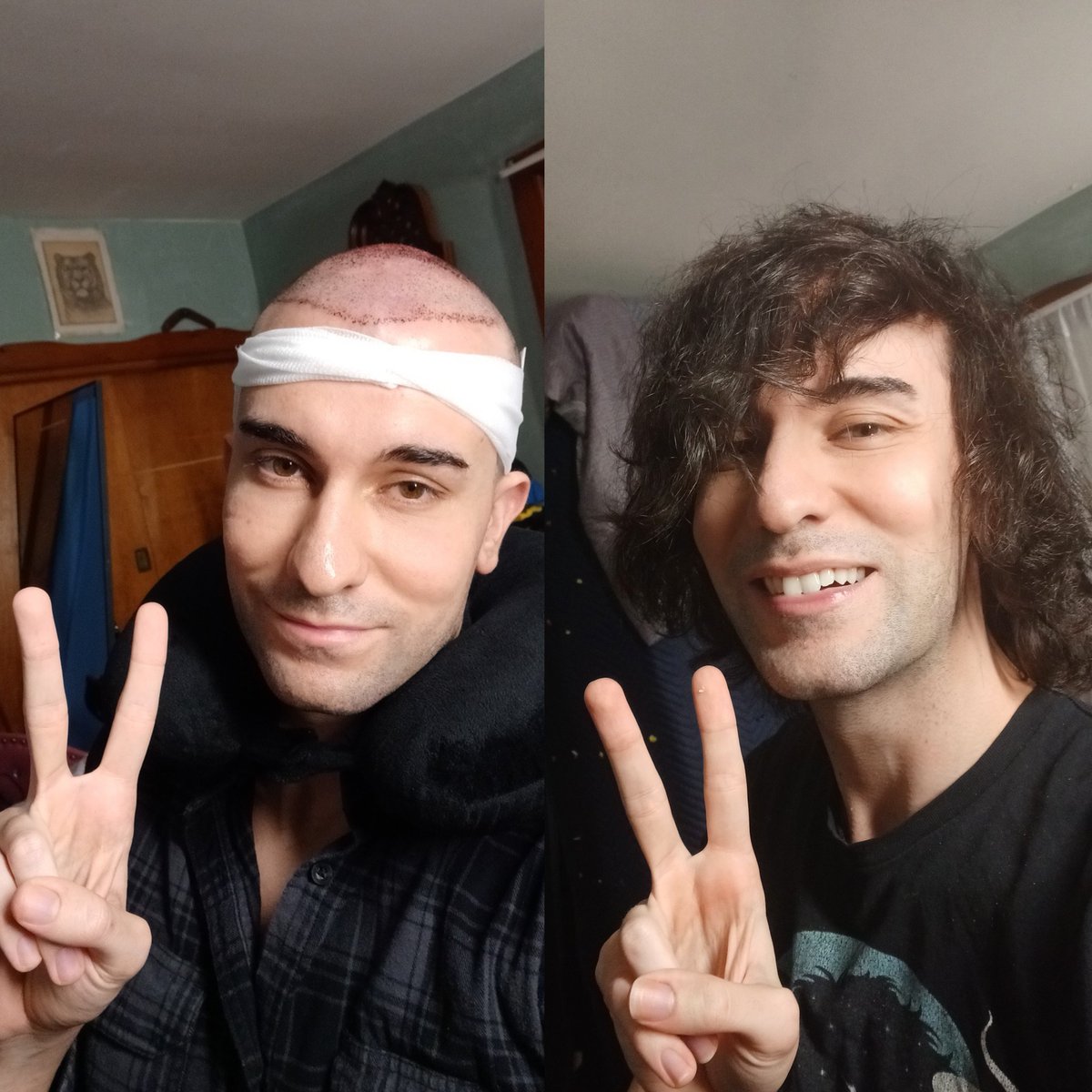LoganRaposo_'s tweet photo. 1 year post op on my hair transplant
You can see the original day 0 picture before I began my hair recovery journey and present day.
It's been a wild ride thus far.
#HairTransplant #HairRecovery #HairHealth https://t.co/h6wFSbI77u