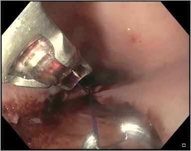 videogie's tweet photo. VideoGIE Editor's Choice: “Endoscopic management of a massive esophageal perforation following pneumatic dilation” by Ikechukwu Achebe et al. https://t.co/dOPgcSi3PQ

@KaraRaphael https://t.co/CbZbqheawI