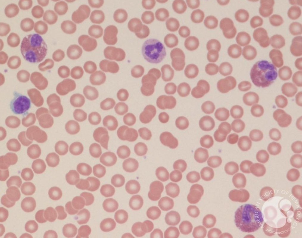 Hey #Medicine residents 👋🏼

Time to talk about EOSINOPHILS today!

Not as common a consult as thrombocytopenia &amp; anemia but important nonetheless 🤷🏼

A short 🧵 to touch upon all things eosinophilia 👇🏻

#MedTwitter