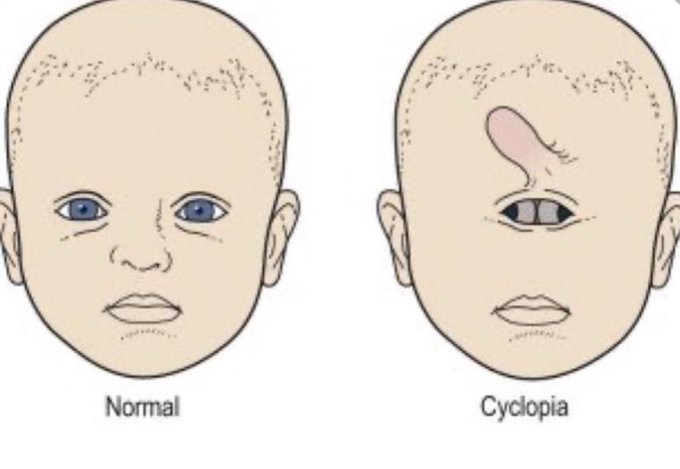 Cyclopia ialah sejenis cacat kelahiran yang mana bayi lahir dengan satu mata  dan biasanya tanpa hidung. Kemudian terdapat organ baru yang kelihatan seperti hidung (dipanggil proboscis) terbentuk di atas mata.

Bayi yang lahir dalam keadaan ini tidak selamat. Beberapa jam selepas