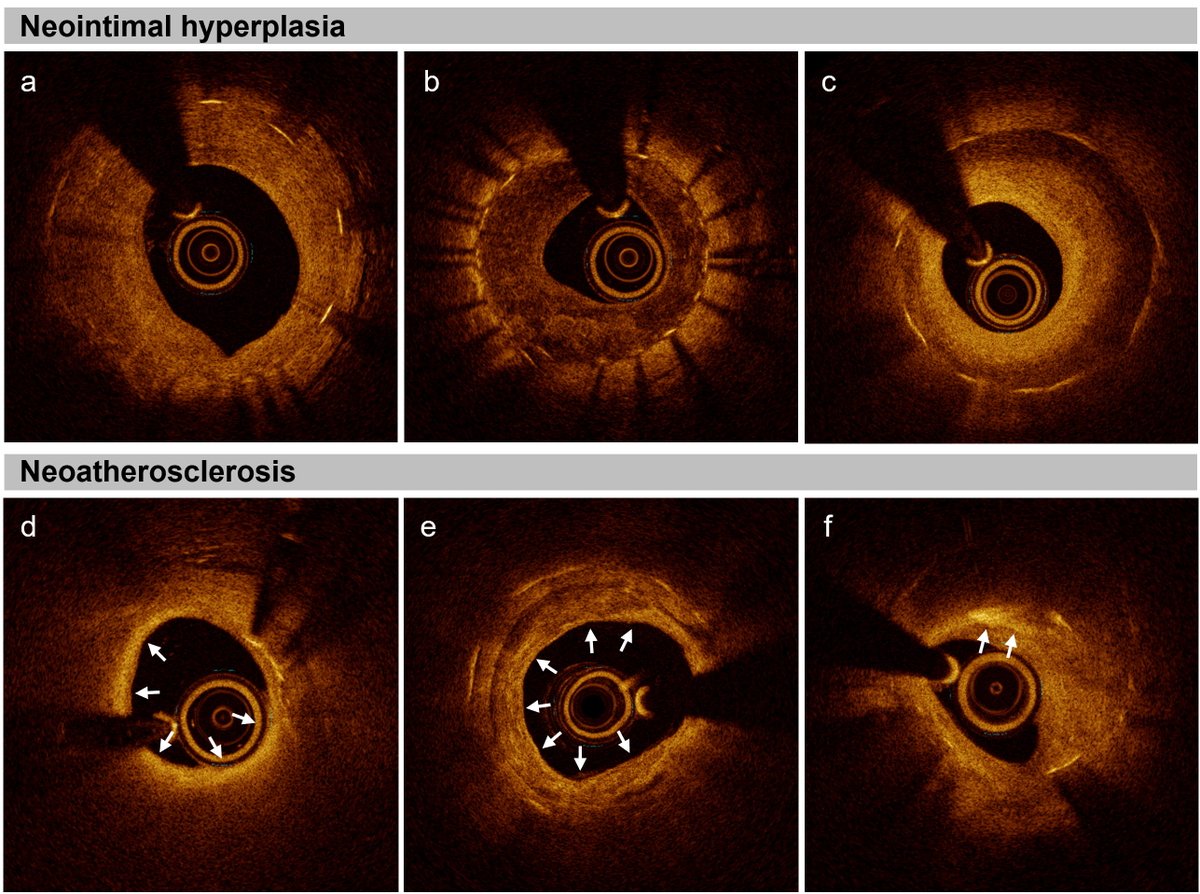 Susie Sun (@susiesu11733465) on Twitter photo #RCM Sharing a New Review🌟
"Recent Advances in the Treatment of #Coronary In-Stent #Restenosis"
from <a href="/mauro_gitto/">Mauro Gitto</a>, <a href="/AngeloOliva3/">Angelo Oliva MD</a>, <a href="/Drroxmehran/">Dr Roxana Mehran</a>, <a href="/RaberLorenz/">Lorenz Räber, MD PhD</a>, <a href="/AlessSpirito/">Alessandro Spirito</a> et al.
#ISR #stent #revascularization #PCI #DES
📤Full Text:
imrpress.com/journal/RCM/25… #RCM Sharing a New Review🌟
"Recent Advances in the Treatment of #Coronary In-Stent #Restenosis"
from <a href="/mauro_gitto/">Mauro Gitto</a>, <a href="/AngeloOliva3/">Angelo Oliva MD</a>, <a href="/Drroxmehran/">Dr Roxana Mehran</a>, <a href="/RaberLorenz/">Lorenz Räber, MD PhD</a>, <a href="/AlessSpirito/">Alessandro Spirito</a> et al.
#ISR #stent #revascularization #PCI #DES
📤Full Text:
imrpress.com/journal/RCM/25…