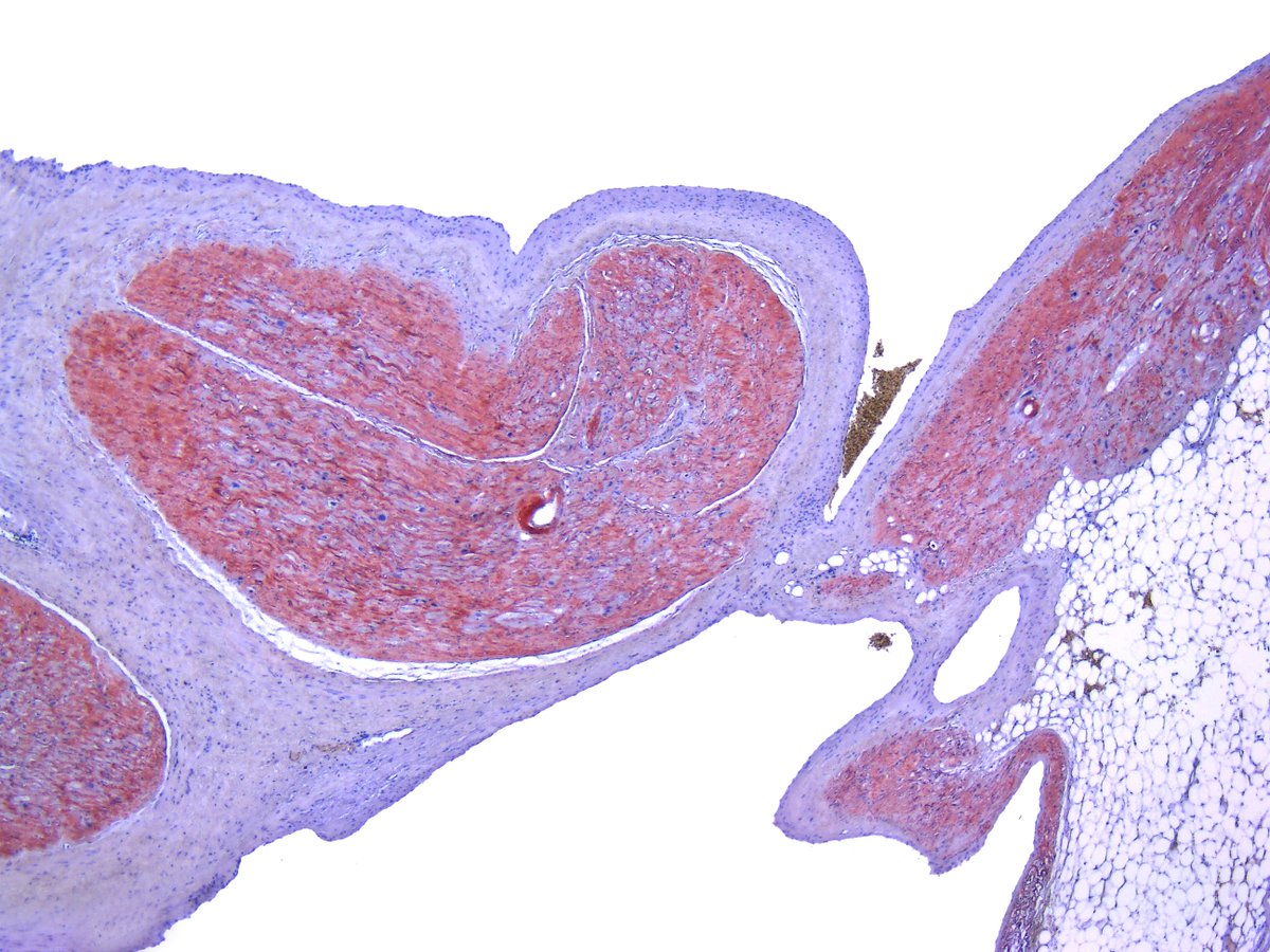 Pathology Walker@Auto Tweet Bot tweet media