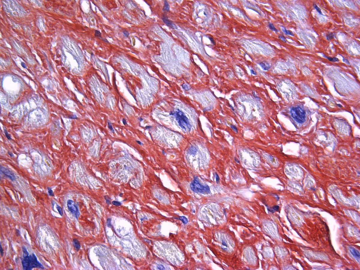 Pathology Walker@Auto Tweet Bot tweet media