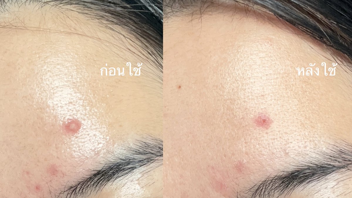 เคยลงเป็น Fav. เจลแต้มสิวที่ชอบปีก่อน ยังยืนยันว่า CURA-MD หลอดเหลือง เป็นโน 1 เหมือนเดิม สิวยุบไวในข้ามคืน ลดอักเสบดีมาก ทาแล้วไม่แสบหน้า ไม่เป็นขุย ไม่ลอก เอาจริงแค่ 4 ชม.ก็ยุบนะ ใช้คู่กับ Cleansing Gel ดีมาก ไอเลิฟความที่ไม่ดันสิว แล้วผิวยังชุ่มชื้นอยู่ ดีมากกก https://t.co/OxFgWTbYas