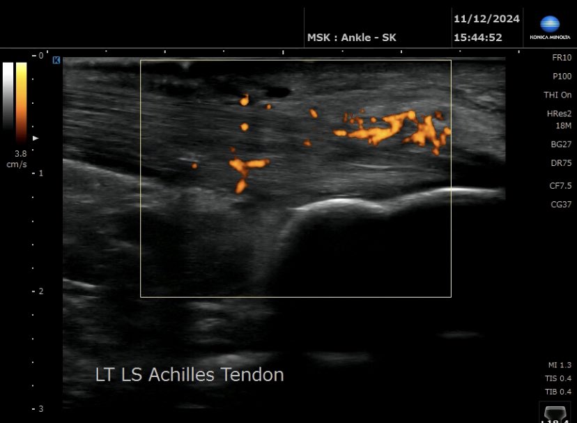 Severe insertional Achilles tendinopathy with insterstitial tear and pre-Achilles bursitis.

Onset 4 months ago in runner following 2 week holiday, return to running and change of running shoes. Had been working on loading exercises but symptoms worsening &amp; struggling to walk