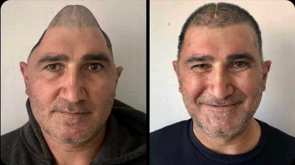 Craniography

Waatan sababta Iran Dhanka Cafimadka Logala Dagalamo Best Cranial Surgery.