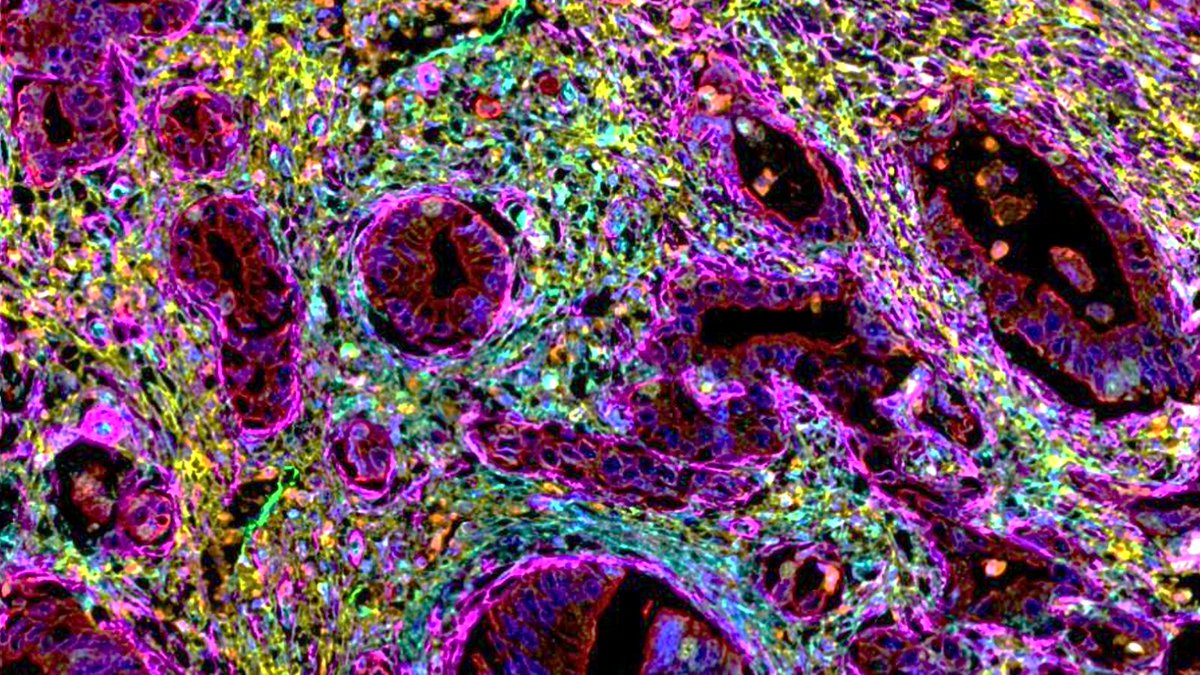Barts Cancer Institute (Queen Mary) (@qmbci) on Twitter photo 📰 Study sheds new light on pancreatic cancer and how non-cancerous cells may weaken the immune system's response and impact patients' survival.
Read more: bit.ly/3OTguZS
<a href="/QMUL/">Queen Mary University of London</a> | <a href="/QMULBartsTheLon/">Barts and The London, Queen Mary</a> | <a href="/LabKocher/">KocherLab</a> 📰 Study sheds new light on pancreatic cancer and how non-cancerous cells may weaken the immune system's response and impact patients' survival.
Read more: bit.ly/3OTguZS
<a href="/QMUL/">Queen Mary University of London</a> | <a href="/QMULBartsTheLon/">Barts and The London, Queen Mary</a> | <a href="/LabKocher/">KocherLab</a>