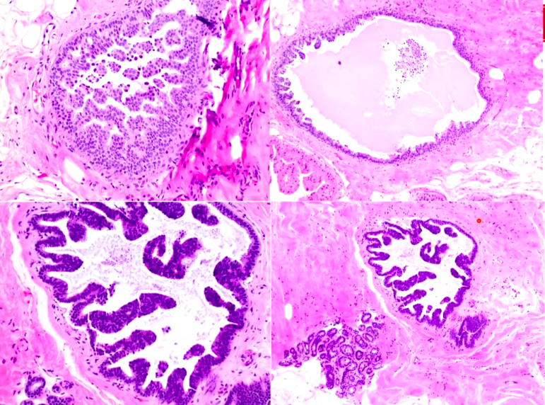 Janiranavarro's tweet photo. Breast-Atypical ductal hyperplasia (ADH) patterns
Cribriform pattern (pic 2)
Micropapillary pattern (pic 3)
Solid pattern (pic 4)
Dr. Li #CAP24 #pathology #pathologists #PathTwitter #PathX #pathresidents #pathfellow #breastpath