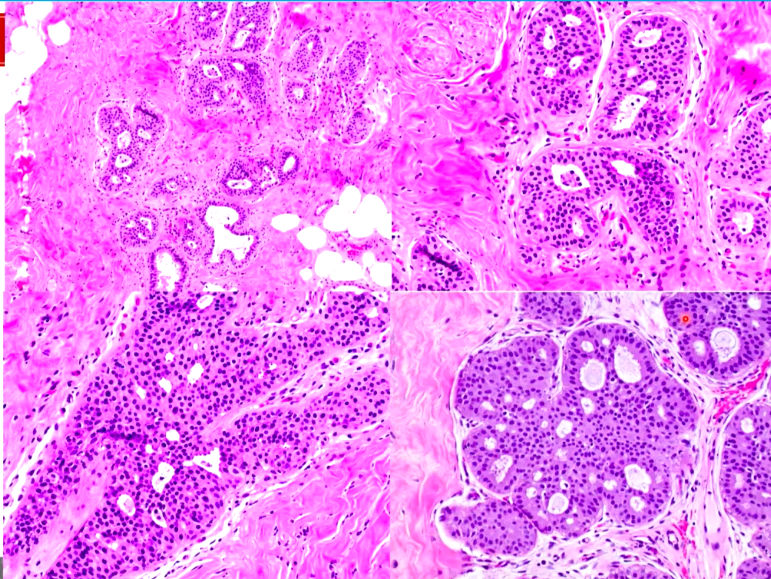 Janiranavarro's tweet photo. Breast-Atypical ductal hyperplasia (ADH) patterns
Cribriform pattern (pic 2)
Micropapillary pattern (pic 3)
Solid pattern (pic 4)
Dr. Li #CAP24 #pathology #pathologists #PathTwitter #PathX #pathresidents #pathfellow #breastpath