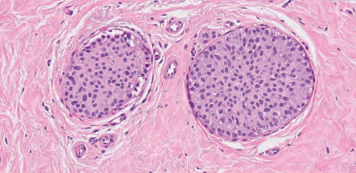 Janiranavarro's tweet photo. Breast-Atypical ductal hyperplasia (ADH) patterns
Cribriform pattern (pic 2)
Micropapillary pattern (pic 3)
Solid pattern (pic 4)
Dr. Li #CAP24 #pathology #pathologists #PathTwitter #PathX #pathresidents #pathfellow #breastpath