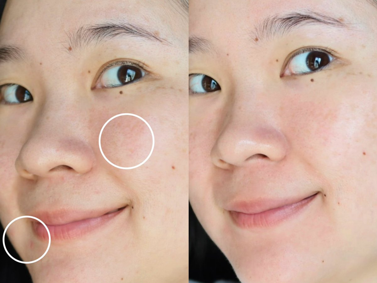 คู่หูลดสิวยกให้ โฟมล้างหน้า+เจลแต้มสิวของ CURA-MD สิวผื่น สิวอุดตันลดลง ผื่นแดงที่ชอบขึ้นเวลาเจอฝุ่น คือดีขึ้นมากกแกรร ตัวโฟมล้างแล้วหน้าไม่แห้ง ล้างสะอาดเลยยยหลังลงสกินแคร์ป้ายเจลแต้มสิวต่อนวดๆให้ซึมลงผิว แค่นี้จบ! #ใช้ดีบอกต่อ https://t.co/RkMy1Y5yBM
