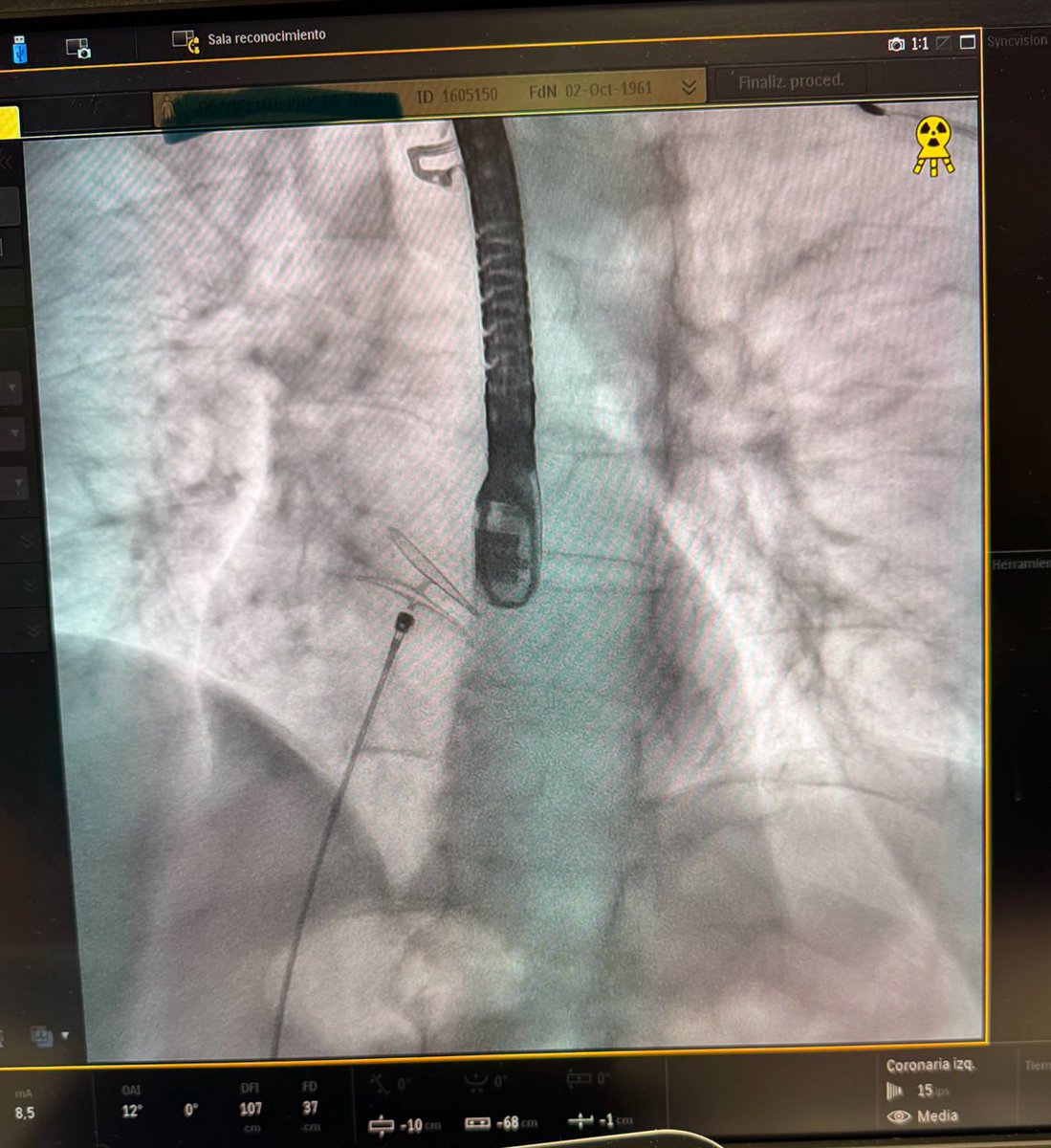 SMT Iberia (@iberiasmt) on Twitter photo Sesión de formación hoy con el dispositivo de cierre de FOP #Ceraflex en <a href="/Hemodin_LaPaz/">Hemodinamica_LaPaz</a> con <a href="/hemodin90/">Guillermo Galeote</a> y <a href="/ari_gonzalvez/">Ariana Gonzálvez</a> y Cardiólogos del Hospital de Mérida <a href="/rocroddel/">Rocío Rodríguez</a> y <a href="/Javiercoma/">Javier Corral</a>
Descargo de responsabilidad: CERAFLEX es una marca comercial de Lifetech Scientific (Shenzhen) Sesión de formación hoy con el dispositivo de cierre de FOP #Ceraflex en <a href="/Hemodin_LaPaz/">Hemodinamica_LaPaz</a> con <a href="/hemodin90/">Guillermo Galeote</a> y <a href="/ari_gonzalvez/">Ariana Gonzálvez</a> y Cardiólogos del Hospital de Mérida <a href="/rocroddel/">Rocío Rodríguez</a> y <a href="/Javiercoma/">Javier Corral</a>
Descargo de responsabilidad: CERAFLEX es una marca comercial de Lifetech Scientific (Shenzhen)