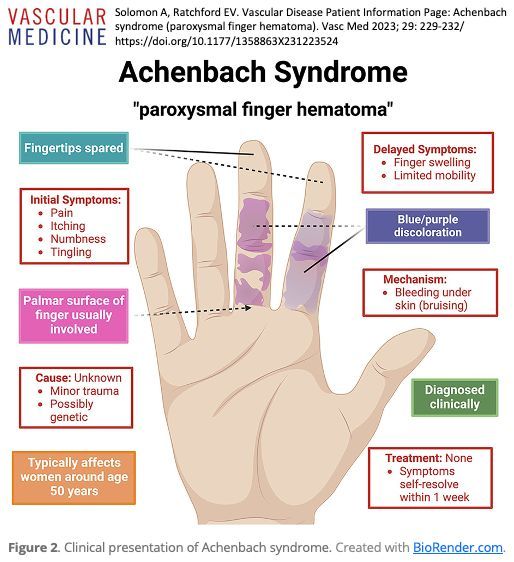 VascularMedicine (@vmj_svm) on Twitter photo Day 1 of #12DaysofVascularMedicine
The most-read #patientinfo page of 2024 is “Achenbach syndrome (paroxysmal finger hematoma)” by <a href="/PagingDrSolomon/">Alexandra Lauren</a> <a href="/evratchford/">Elizabeth Ratchford</a>
buff.ly/4g9ZBpJ Day 1 of #12DaysofVascularMedicine
The most-read #patientinfo page of 2024 is “Achenbach syndrome (paroxysmal finger hematoma)” by <a href="/PagingDrSolomon/">Alexandra Lauren</a> <a href="/evratchford/">Elizabeth Ratchford</a>
buff.ly/4g9ZBpJ