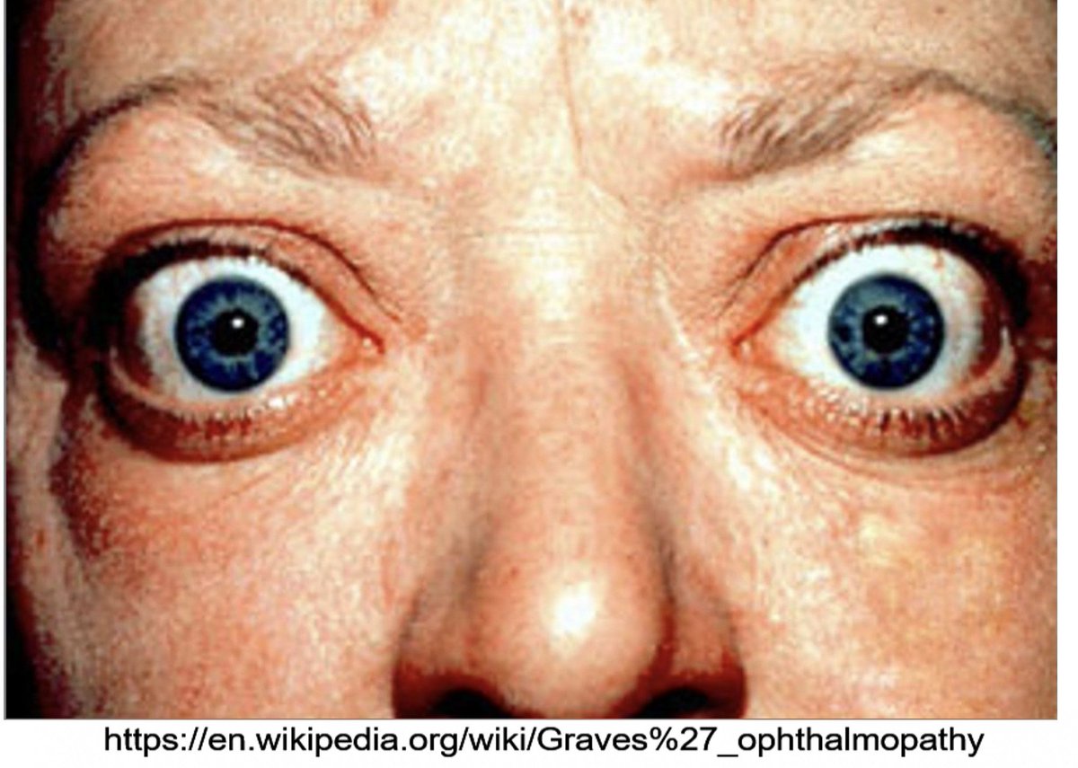 American Association of Endocrine Surgeons (@theaaes) on Twitter photo Graves' disease is associated with inflammation of the eyes; symptoms may include bulging eyes, dry or gritty eyes, irritation or redness, pain or pressure, double vision, light sensitivity, eyelid retraction, tearing or watery eyes, difficulty closing eyes). #GDAM2024 <a href="/GDATF/">Graves' Disease & Thyroid Foundation</a> Graves' disease is associated with inflammation of the eyes; symptoms may include bulging eyes, dry or gritty eyes, irritation or redness, pain or pressure, double vision, light sensitivity, eyelid retraction, tearing or watery eyes, difficulty closing eyes). #GDAM2024 <a href="/GDATF/">Graves' Disease & Thyroid Foundation</a>