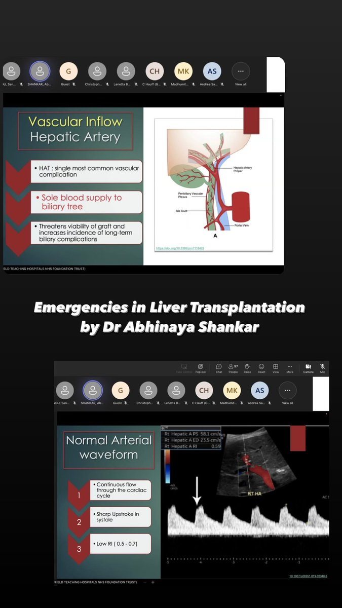 Brilliant talk on Emergencies in Liver Transplantation by Dr Abhinaya Shankar who is a Consultant Radiologist at Sheffield Teaching Hospitals NHS Foundation Trust, in Emergency Radiology with special interest in GI and HPB Radiology #BSER2024