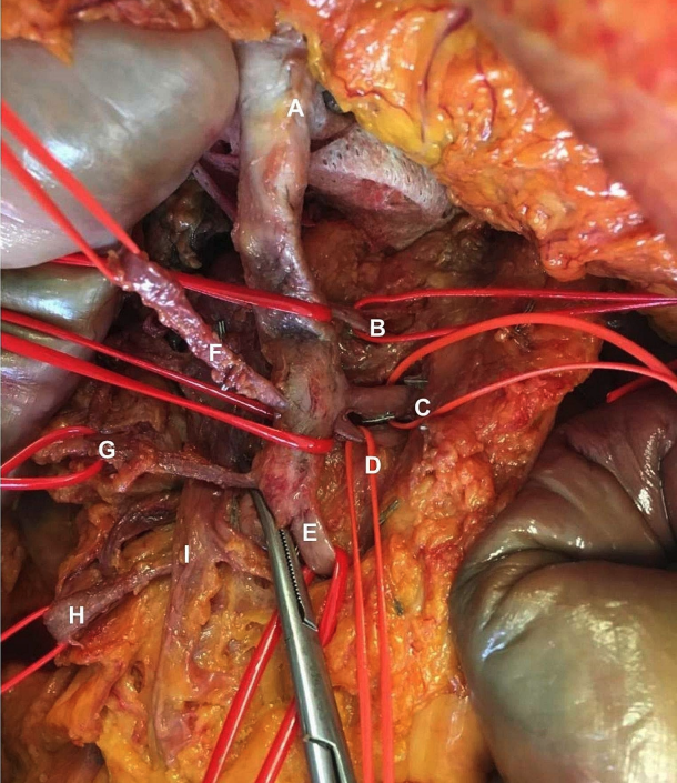 ✨The end of2⃣0⃣2⃣4⃣nears - over the next days, 🔝10 papers that have changed my practice &amp; shaped research

Start with anatomy review of SMA branches👉tinyurl.com/mr3kdkxz
Branch 1 &amp; 2 perfuse mean 195cm small intestine
➡️Many proximal #NETs mesenteric masses can be resected