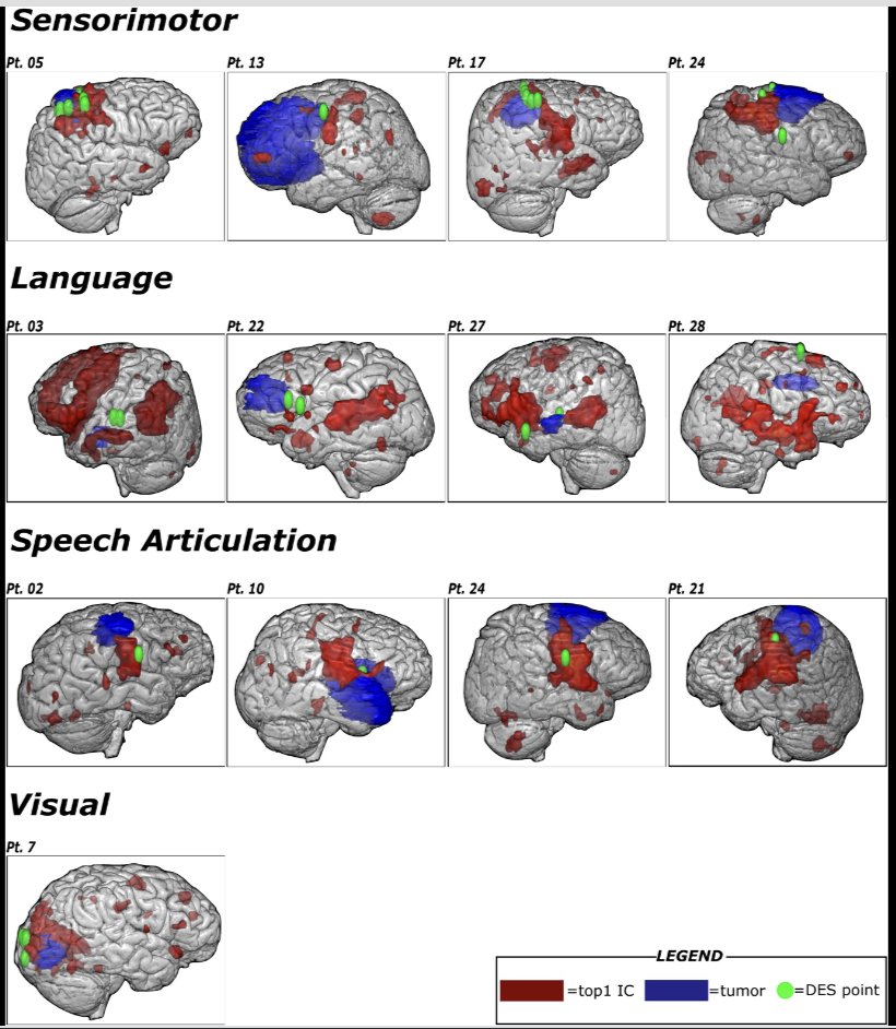 Neurosurgery Publications (@neurosurgerycns) on Twitter photo #NEUNew Resting State Functional Networks in Gliomas: Validation With Direct Electric Stimulation Using a New Tool for Planning Brain Resections bit.ly/4g7xBmz by Moretto et al <a href="/cimec_unitrento/">CIMeC UniTrento</a> <a href="/CNS_Update/">CNS</a> <a href="/IsaacYangMD/">Isaac Yang MD</a> <a href="/DKondziolkaCNS/">Douglas Kondziolka</a> #NEUNew Resting State Functional Networks in Gliomas: Validation With Direct Electric Stimulation Using a New Tool for Planning Brain Resections bit.ly/4g7xBmz by Moretto et al <a href="/cimec_unitrento/">CIMeC UniTrento</a> <a href="/CNS_Update/">CNS</a> <a href="/IsaacYangMD/">Isaac Yang MD</a> <a href="/DKondziolkaCNS/">Douglas Kondziolka</a>