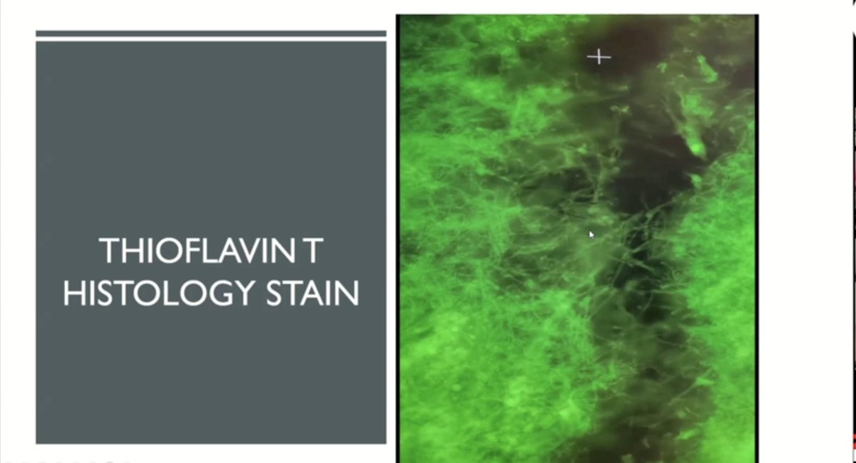 dragonfishy's tweet photo. Looking at the white fibrous (calamari clots) not as the product of a normal coagulation pathway, but as a new form of intravascular polymerisation of fibrinogen monomers in the presence of Tin, active phosphorus heads, and sulphur cross-linking and with spike protein to seed the reaction... is my synthesis.
https://t.co/MrU4UQbpvG
Through the eyes of a polymer chemist, it's more plastic than clot..... He may be right.
Also might explain why standard anticoagulants suck.
It arises out of the data on the compositional elements of the Hirschman "clots"
P.S. When Greg mentioned the number of active phosphorus heads my brain went into a meltdown, it was a number which I can say, boggled me.
P.P.S. More than 3 years of warnings
@r_hirschman @cafelockedout @zeeemedia @OlooneyJohn @NestCommander @HealthRanger @chrismartenson @dbkell @Jikkyleaks @JesslovesMJK