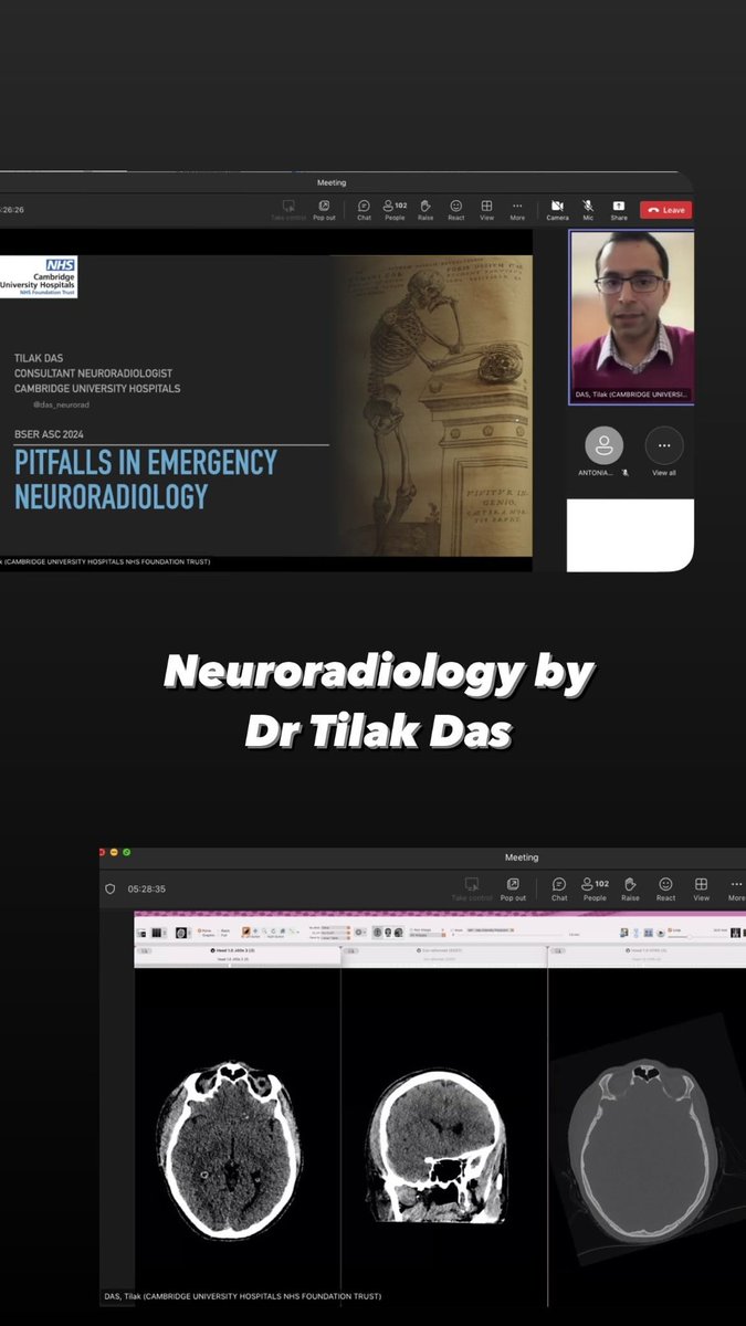 Our neuroradiology talk has begun with Dr Tilak Das! #BSER2024 <a href="/Das_neurorad/">Tilak Das</a>