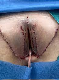 DiscretSexShop's tweet photo. La vaginoplastia de Begoña G. ha quedado muy bien dicen los médicos . #begoña https://t.co/hJwOszdpTg