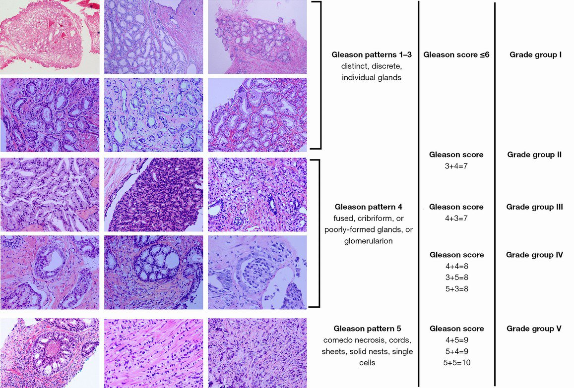 Typical Gleason patterns of the modern Gleason grading system and the corresponding new Grade Group system 🔬
sciencedirect.com/science/articl…