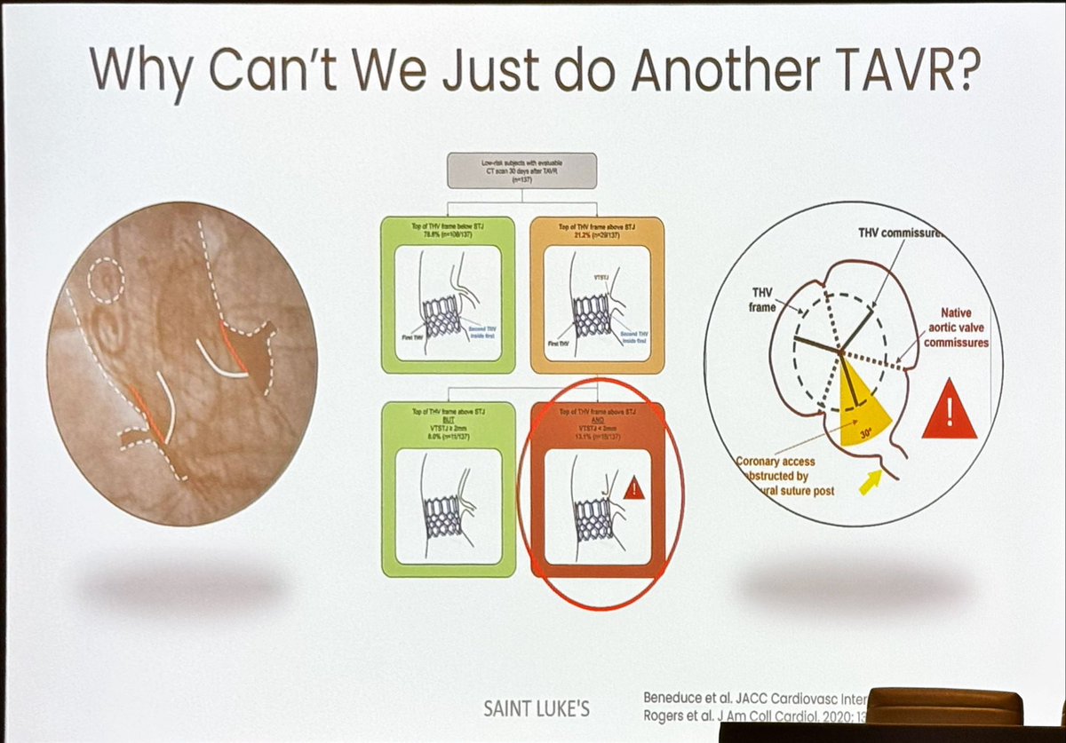 DrMarthaGulati's tweet photo. Dr. Chetan Huded discusses the growing TAVR use in those under 50 years. But what happens when they fail? Why can’t we just do another TAVR?
For some we can.
For ~12% you can’t: possible to block coronary arteries & can be risky
#ConnHeart @MidAmericaHeart #CardioTwitter https://t.co/wons2AJUfe