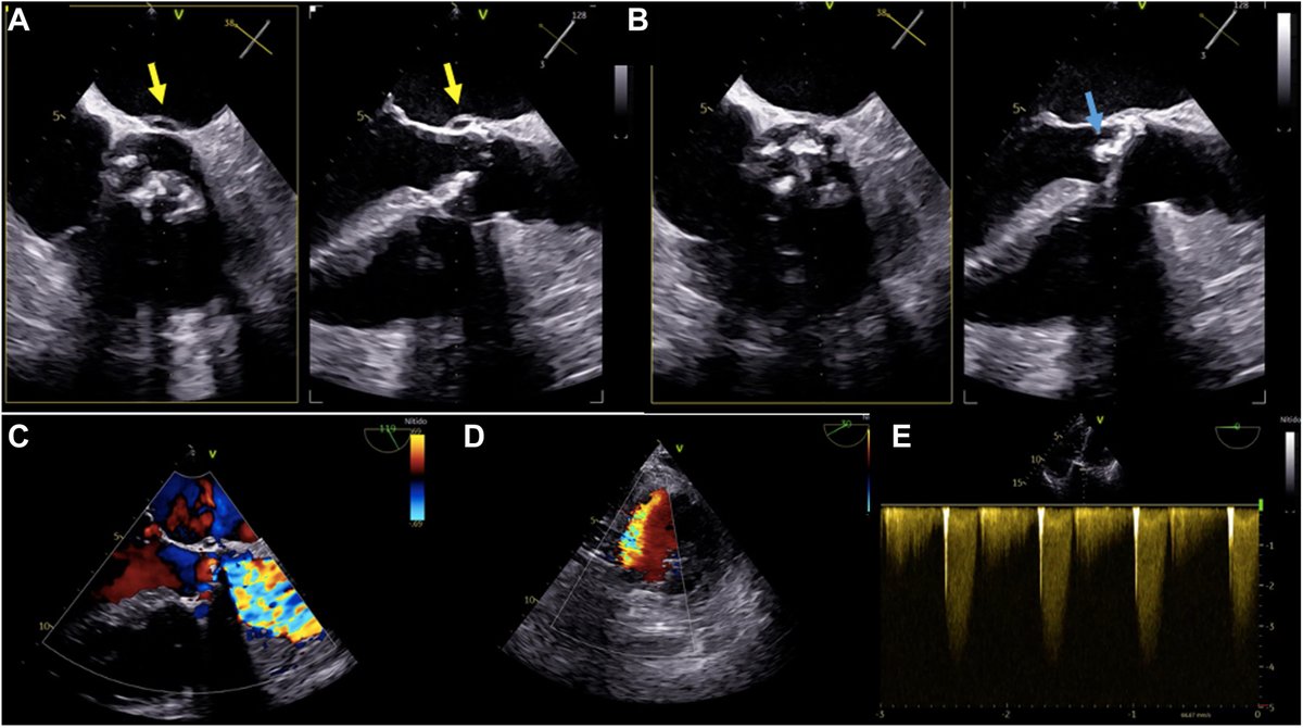 CJC Journals (@cjcjournals) on Twitter photo 📖 Read about a new approach for the treatment of #CardiogenicShock due to #aortic valve injury associated with #endocarditis 👉 onlinecjc.ca/article/S0828-… <a href="/orioldediego/">Oriol de Diego</a> #CJC 📖 Read about a new approach for the treatment of #CardiogenicShock due to #aortic valve injury associated with #endocarditis 👉 onlinecjc.ca/article/S0828-… <a href="/orioldediego/">Oriol de Diego</a> #CJC