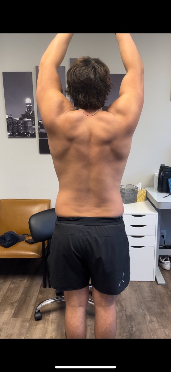 StrattonSpine's tweet photo. As you see at the end of the movement, his right shoulder is closer to his ear due to lack of upward rotation. This is a nightmare for the subacromial space leading to impingement syndrome, bursitis, and possible tendon pathology. #rehab #chiropractic #stratton https://t.co/k0urDRrHrV
