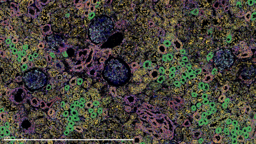 ✨ Spatial Spotlight Series! ✨
This month, we’re spotlighting a stunning MERSCOPE data image of the human kidney cortex, featuring glomeruli &amp; different epithelial cells.
🔬 Transcripts from 140 gene panel
🟢 UMOD
🔵 Synaptopodin
📸 credit:<a href="/KuppeChristoph/">Christoph Kuppe</a>, RWTH Aachen University