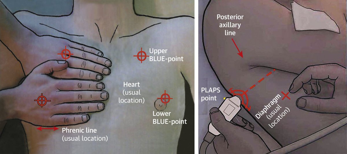 ZHeart11768530's tweet photo. 🔴Lung Ultrasound for the Cardiologist⤵️ State-of-the-Art #2024Review #openaccess 

🔹https://t.co/l1jhezzfsP
 #FOAMed #MedEd #medstudent #paramedic #Cardiology #CardioEd #medtwitter #meded #CardioTwitter #cardiotwiteros  #MedX #cardiovascular #MedTwitter #medical #medEd https://t.co/APrQMGFrQE