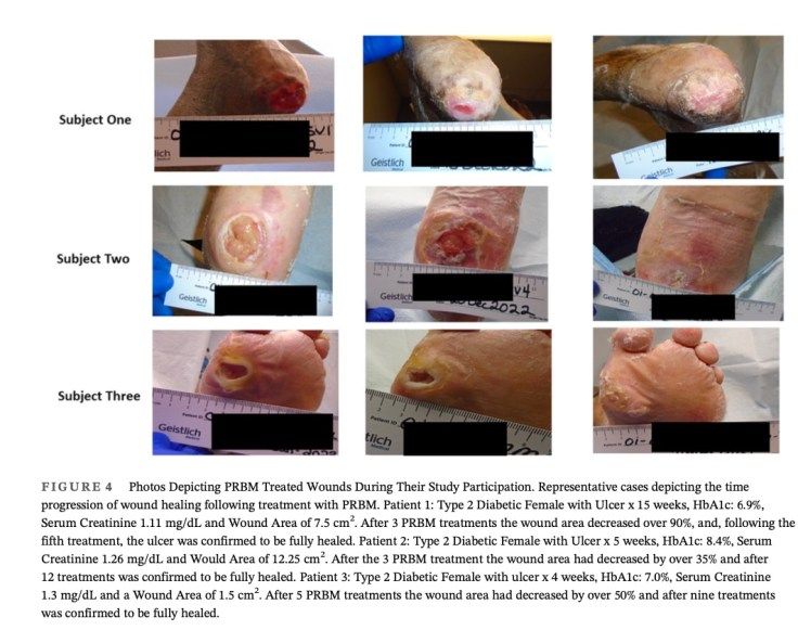 DGArmstrong's tweet photo. Exciting news for diabetic foot ulcer treatment! Check out this blog post on using PRBM as a new tool. #diabeticfootulcer #PRBM #footcare https://t.co/oRKw7VMl5k https://t.co/ynA9W803iS