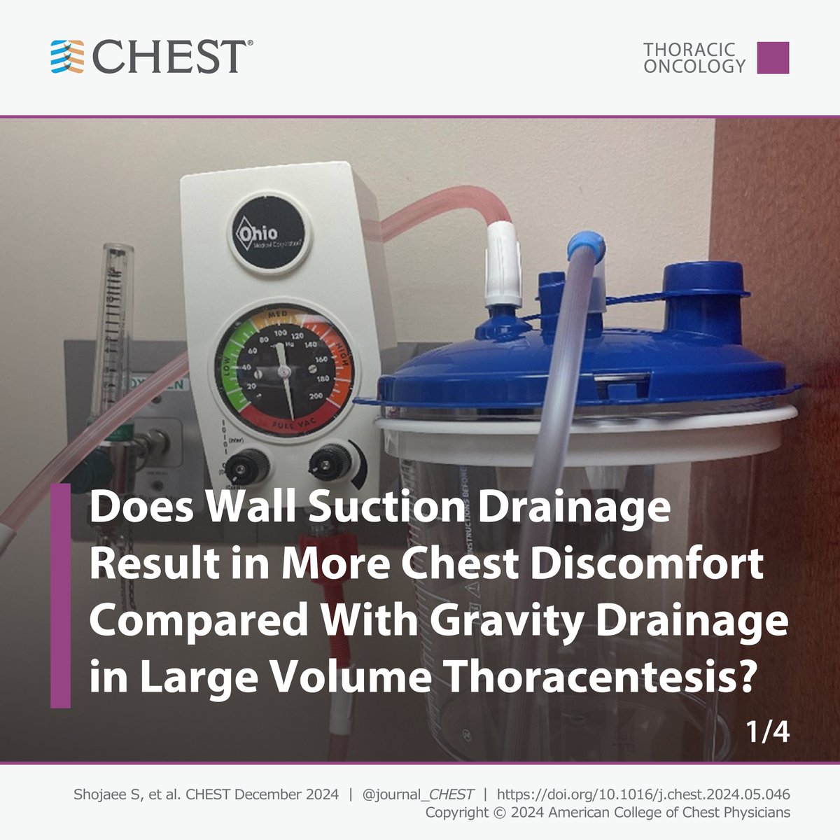 accpchest's tweet image. Does wall suction drainage result in more chest discomfort compared with gravity drainage in patients undergoing large-volume #thoracentesis? Read the full research in the December issue: hubs.la/Q02_lbj30
#MedEd #JournalCHEST