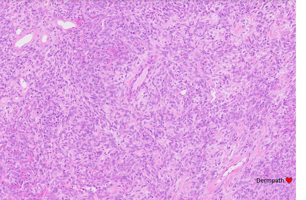 DermpathLove's tweet photo. Female 20s, 'mass right upper arm - subfascial' #dermpath https://t.co/1Exz9s0CZb