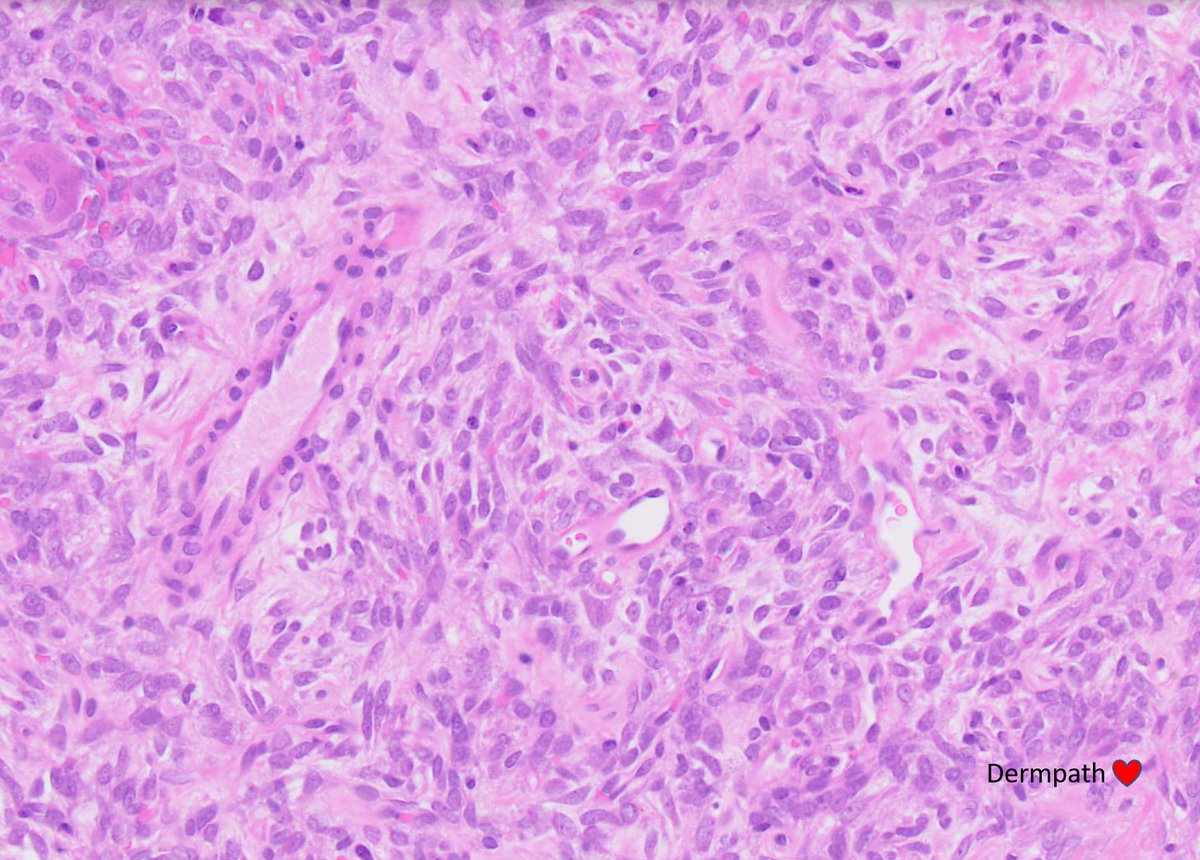 DermpathLove's tweet photo. Female 20s, 'mass right upper arm - subfascial' #dermpath https://t.co/1Exz9s0CZb
