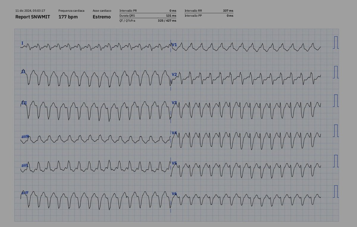 DocEmRu's tweet image. Male, 56 YO, comes to the ER for palpitations started 1 hout prior.  
ECG post ECV shows NSR with LBBB (did not take photo, Sorry)
ECG machine says PSVT+aberrancy, but cardiologiSTst st was not convinced. thoughts? #MedTwitter #PMcardio @PMcardioApp